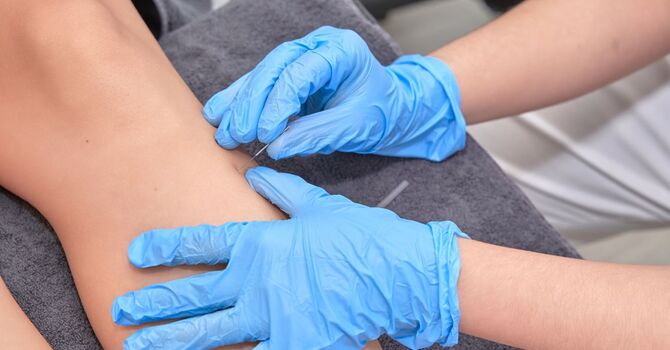 How Dry Needling Therapy Helps Athletes Recover from Injury Faster image